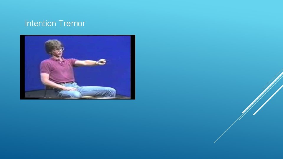Intention Tremor 