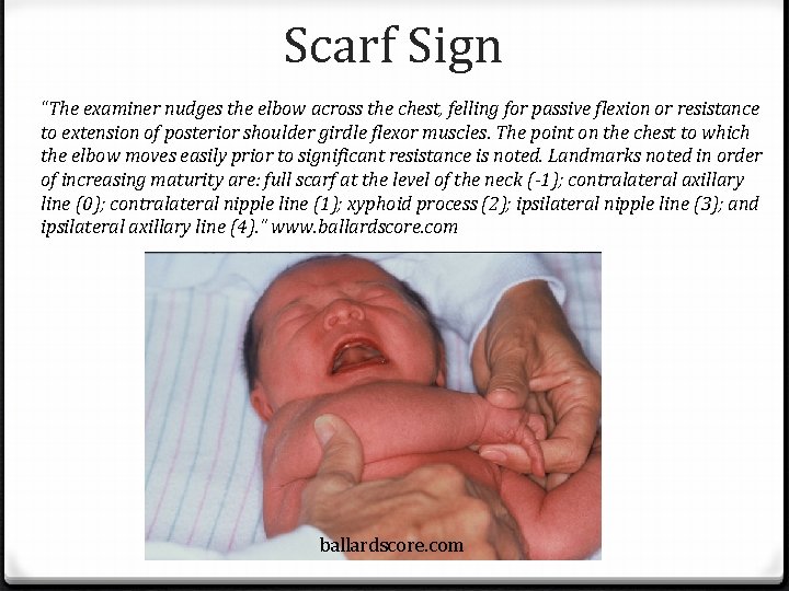 Scarf Sign “The examiner nudges the elbow across the chest, felling for passive flexion