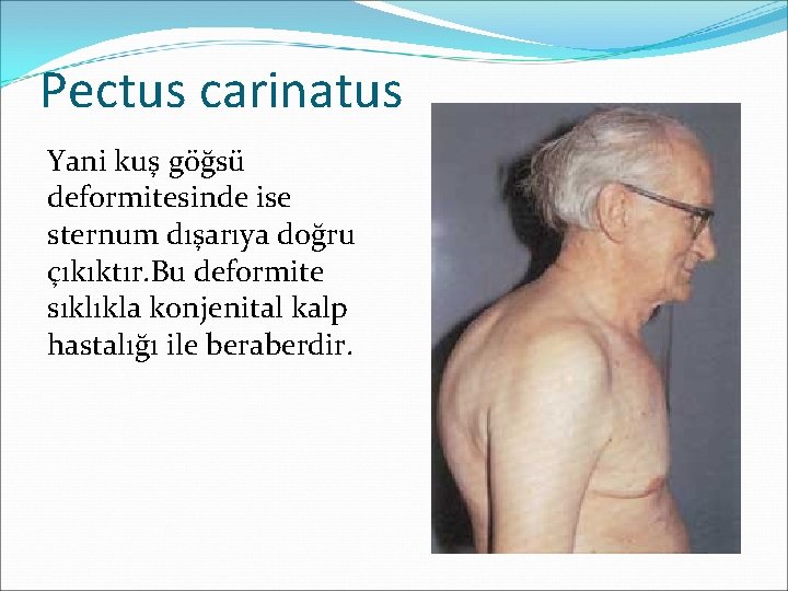 Pectus carinatus Yani kuş göğsü deformitesinde ise sternum dışarıya doğru çıkıktır. Bu deformite sıklıkla