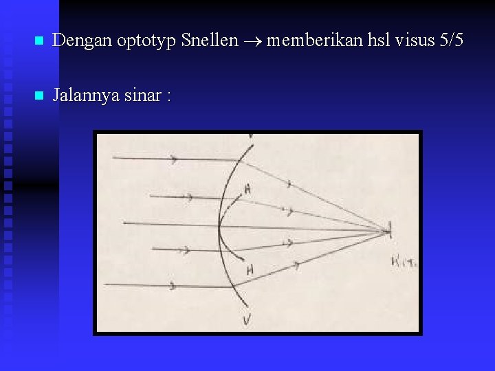  Dengan optotyp Snellen memberikan hsl visus 5/5 Jalannya sinar : 