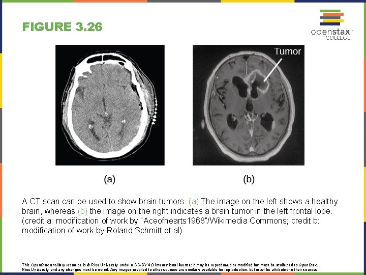 FIGURE 3. 26 A CT scan be used to show brain tumors. (a) The