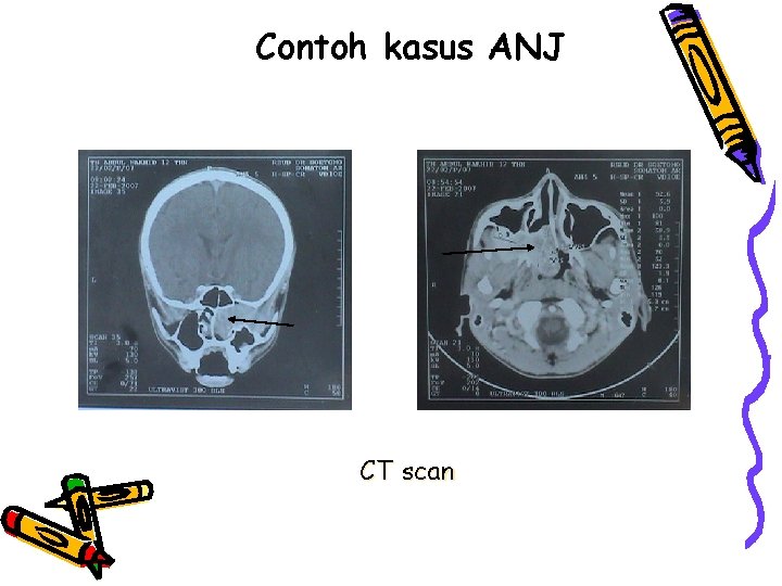 Contoh kasus ANJ CT scan 