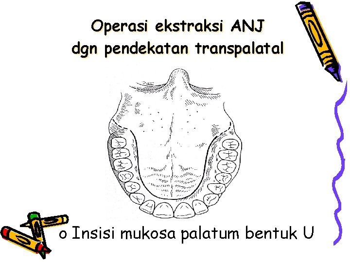Operasi ekstraksi ANJ dgn pendekatan transpalatal o Insisi mukosa palatum bentuk U 
