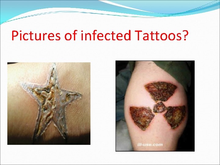 Pictures of infected Tattoos? 