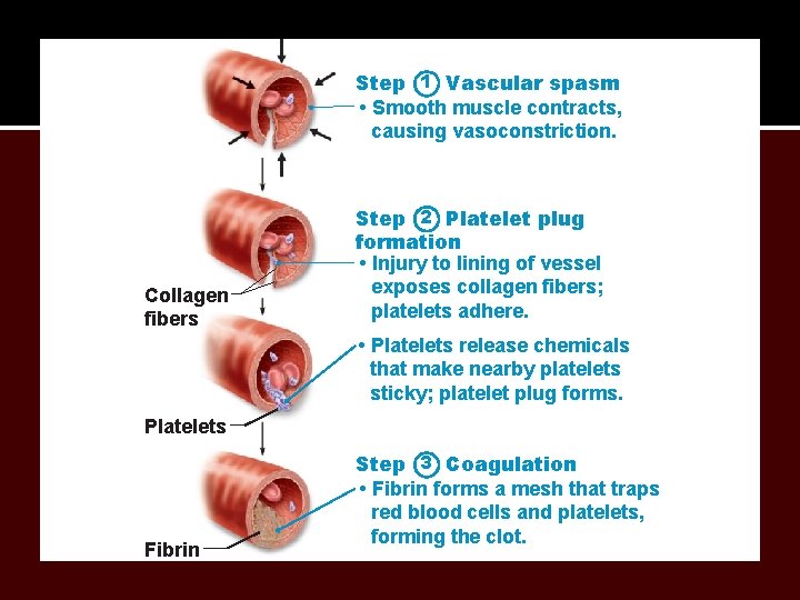 Step 1 Vascular spasm • Smooth muscle contracts, causing vasoconstriction. Collagen fibers Step 2