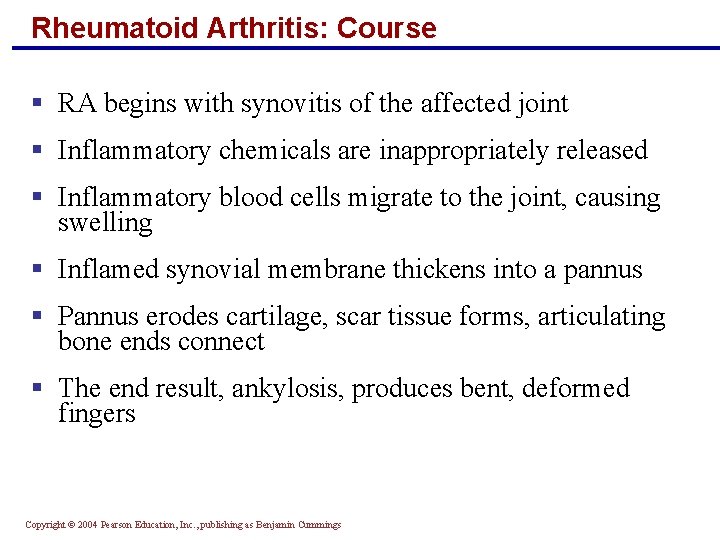 Rheumatoid Arthritis: Course § RA begins with synovitis of the affected joint § Inflammatory