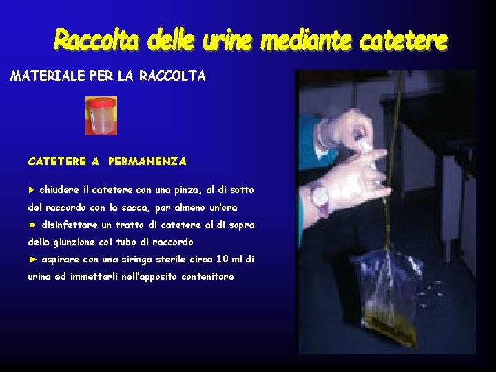 MATERIALE PER LA RACCOLTA CATETERE A PERMANENZA ► chiudere il catetere con una pinza,