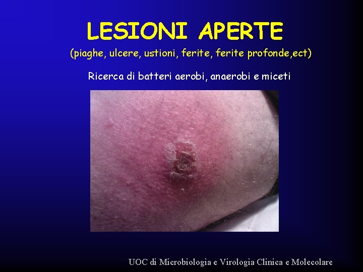 LESIONI APERTE (piaghe, ulcere, ustioni, ferite profonde, ect) Ricerca di batteri aerobi, anaerobi e