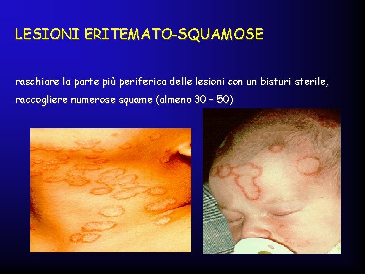 LESIONI ERITEMATO-SQUAMOSE raschiare la parte più periferica delle lesioni con un bisturi sterile, raccogliere