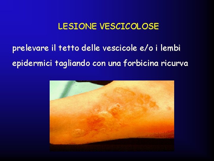 LESIONE VESCICOLOSE prelevare il tetto delle vescicole e/o i lembi epidermici tagliando con una