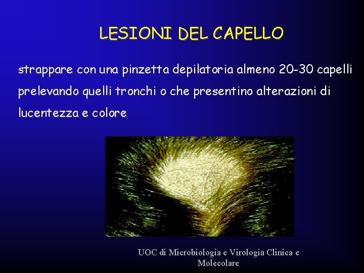 LESIONI DEL CAPELLO strappare con una pinzetta depilatoria almeno 20 -30 capelli prelevando quelli