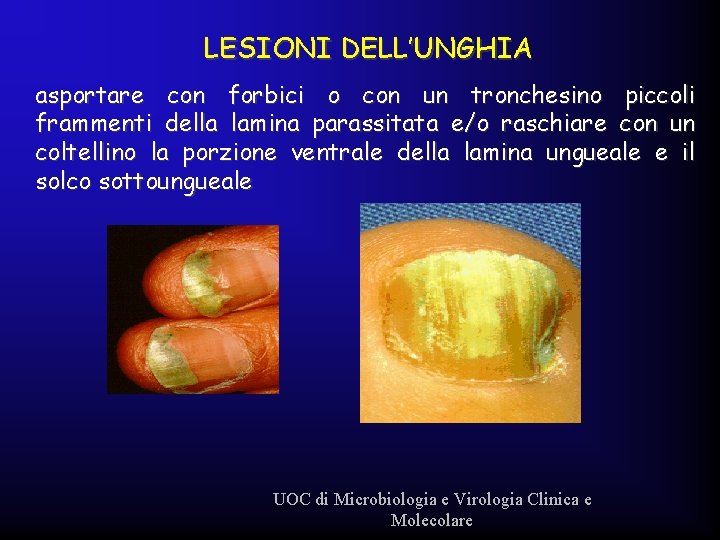 LESIONI DELL’UNGHIA asportare con forbici o con un tronchesino piccoli frammenti della lamina parassitata