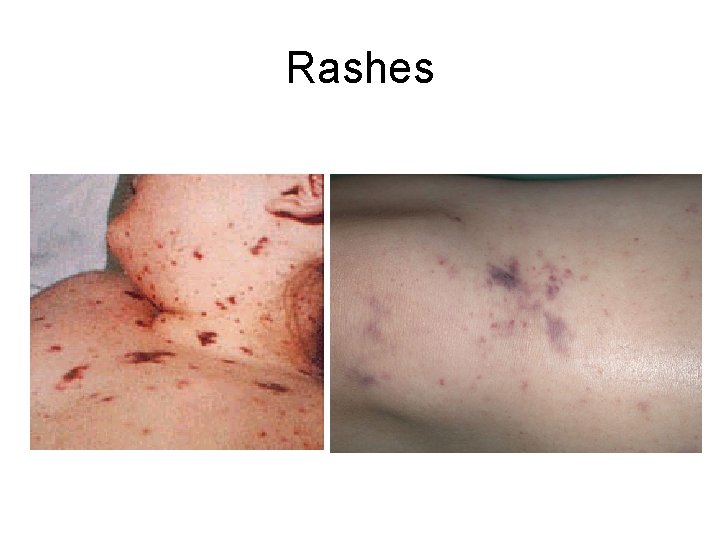 Rashes 