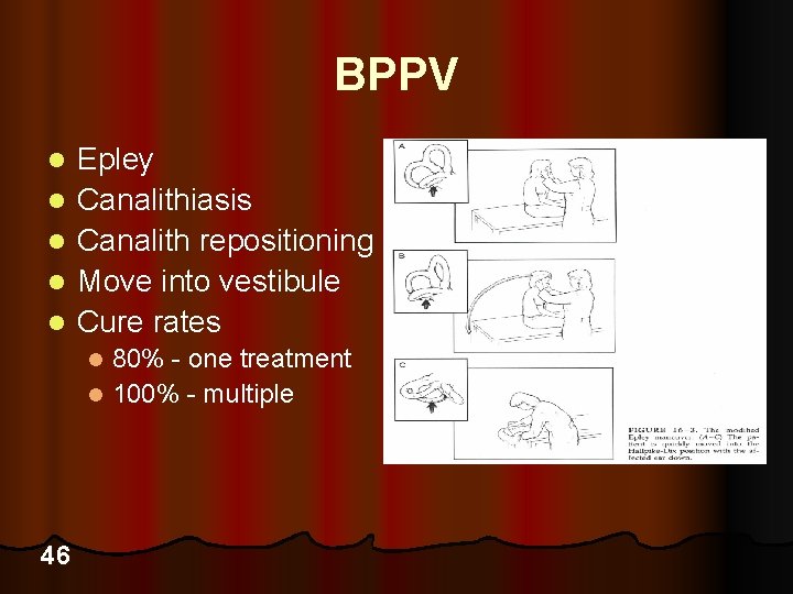 BPPV l l l Epley Canalithiasis Canalith repositioning Move into vestibule Cure rates 80%