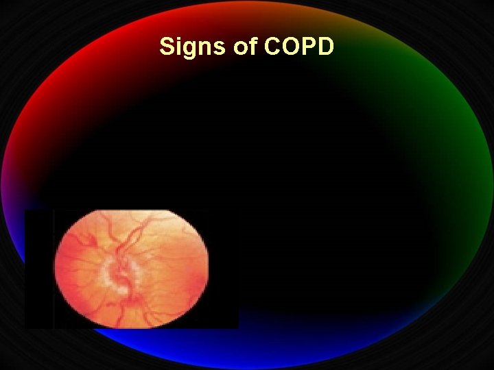 Signs of COPD 