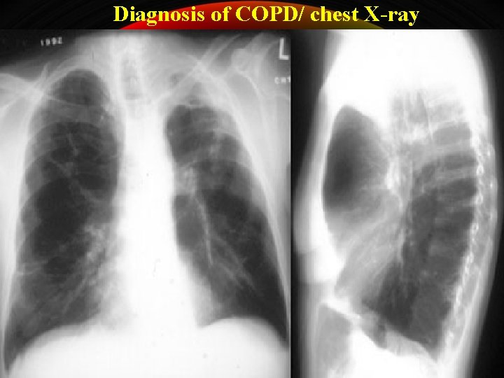 Diagnosis of COPD/ chest X-ray 