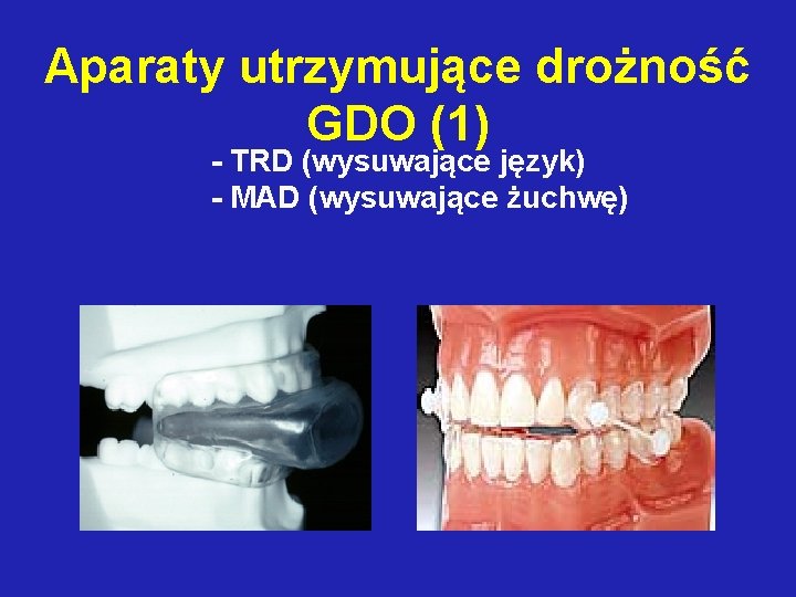 Aparaty utrzymujące drożność GDO (1) - TRD (wysuwające język) - MAD (wysuwające żuchwę) 