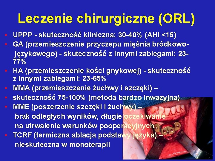 Leczenie chirurgiczne (ORL) • UPPP - skuteczność kliniczna: 30 -40% (AHI <15) • GA