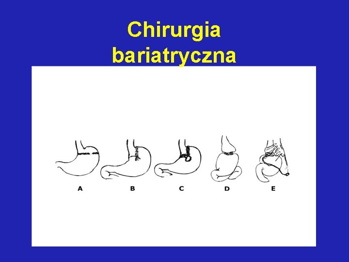 Chirurgia bariatryczna 