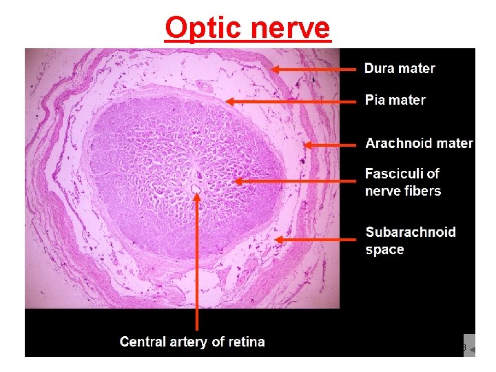 Optic nerve 33 
