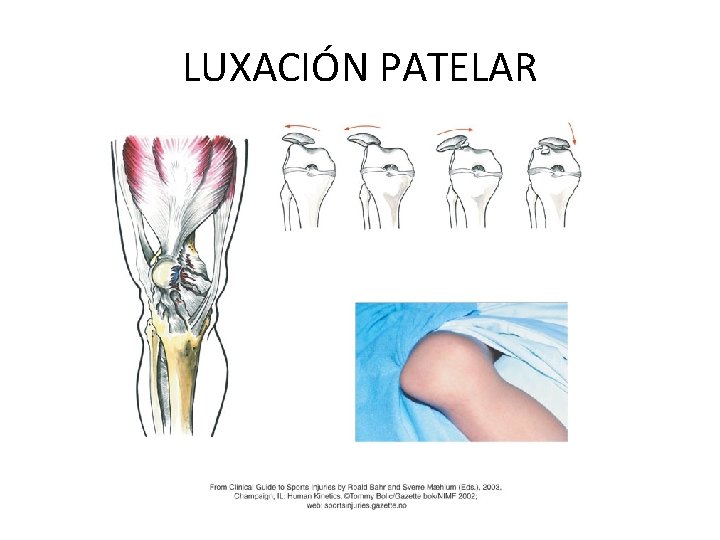 LUXACIÓN PATELAR 