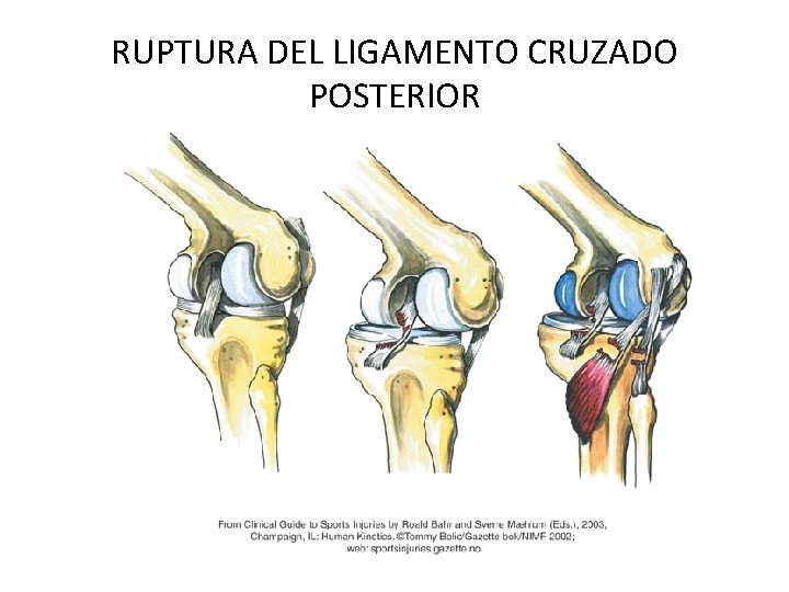 RUPTURA DEL LIGAMENTO CRUZADO POSTERIOR 