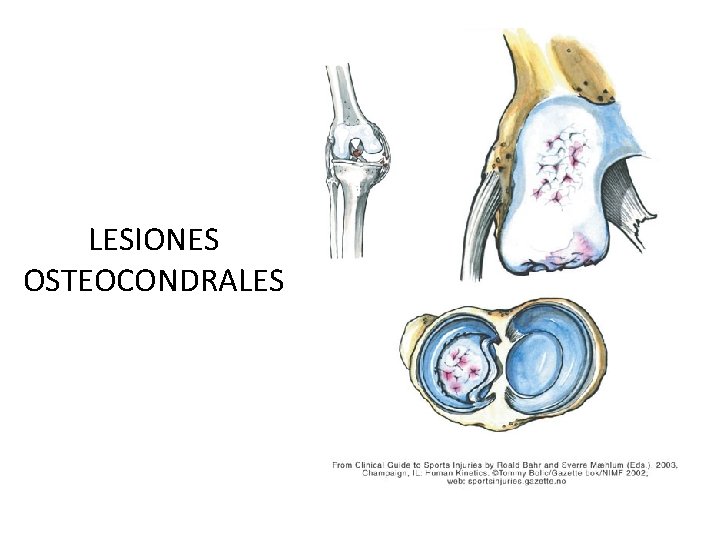 LESIONES OSTEOCONDRALES 