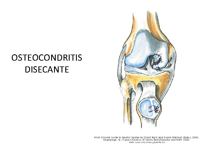 OSTEOCONDRITIS DISECANTE 