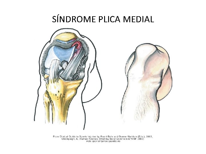 SÍNDROME PLICA MEDIAL 