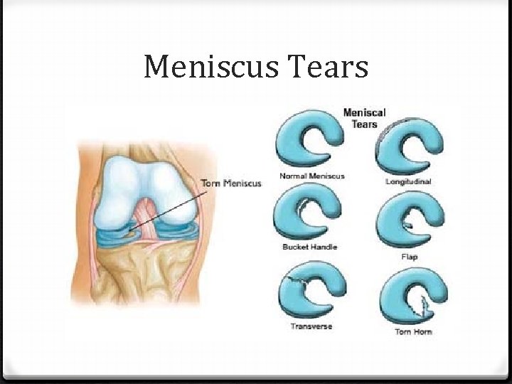 Meniscus Tears 