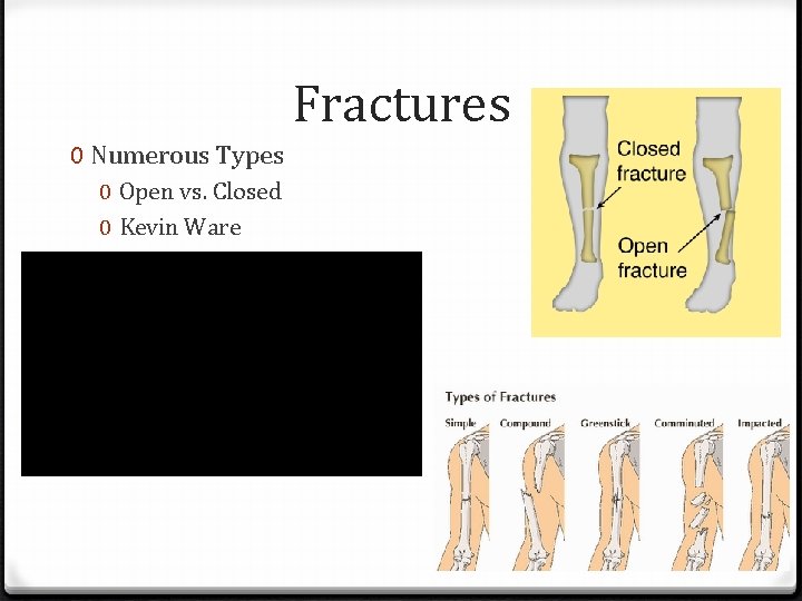 Fractures 0 Numerous Types 0 Open vs. Closed 0 Kevin Ware 