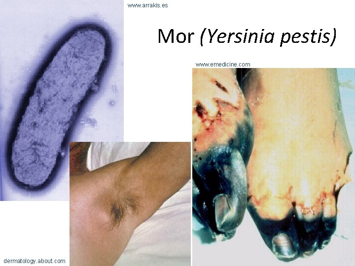 www. arrakis. es Mor (Yersinia pestis) www. emedicine. com dermatology. about. com 
