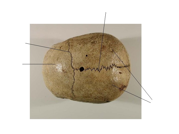 Sagittal suture Coronal suture Frontal Bone Parietal Bones 