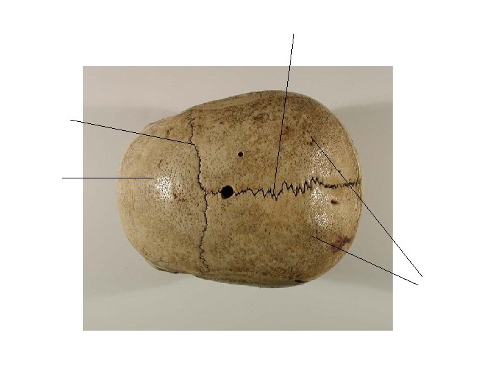 Sagittal suture Coronal suture Frontal Bone Parietal Bones 