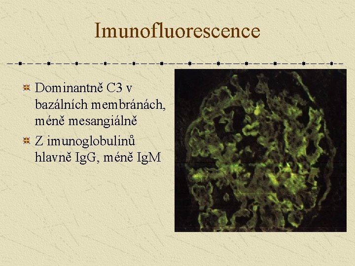 Imunofluorescence Dominantně C 3 v bazálních membránách, méně mesangiálně Z imunoglobulinů hlavně Ig. G,