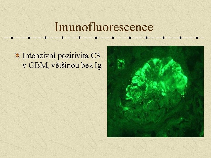 Imunofluorescence Intenzivní pozitivita C 3 v GBM, většinou bez Ig 