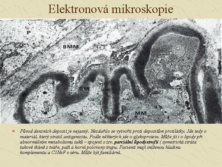 Elektronová mikroskopie Původ denzních depozit je nejasný. Nezdařilo se vytvořit proti depozitům protilátky. Jde