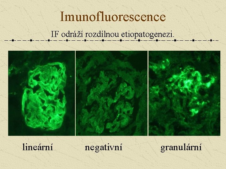 Imunofluorescence IF odráží rozdílnou etiopatogenezi. lineární negativní granulární 