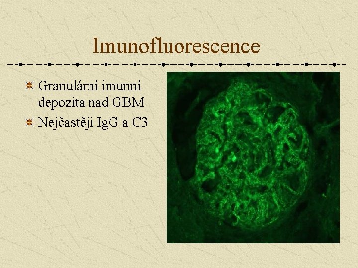 Imunofluorescence Granulární imunní depozita nad GBM Nejčastěji Ig. G a C 3 