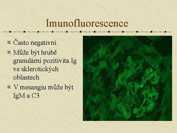 Imunofluorescence Často negativní. Může být hrubě granulární pozitivita Ig ve sklerotických oblastech V mesangiu