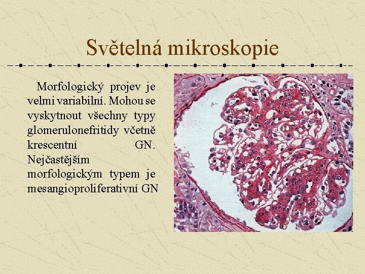 Světelná mikroskopie Morfologický projev je velmi variabilní. Mohou se vyskytnout všechny typy glomerulonefritidy včetně