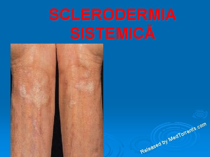 Sclerodermie Sistemica - definitie | volksparts.ro