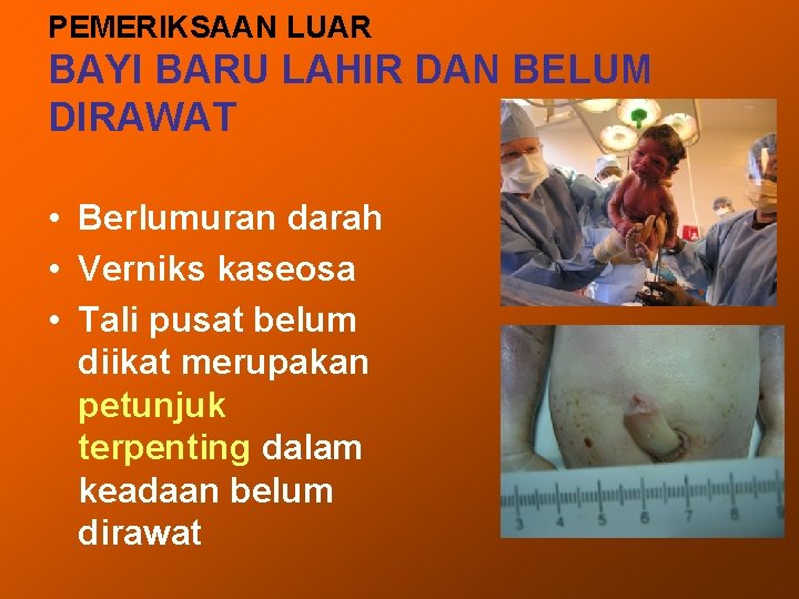 PEMERIKSAAN LUAR BAYI BARU LAHIR DAN BELUM DIRAWAT • Berlumuran darah • Verniks kaseosa