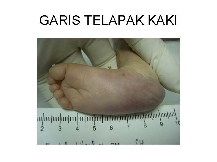 GARIS TELAPAK KAKI 