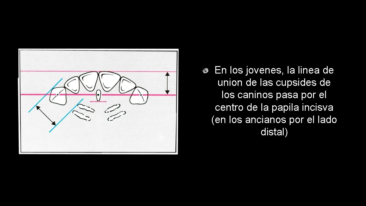 En los jovenes, la linea de union de las cupsides de los caninos pasa