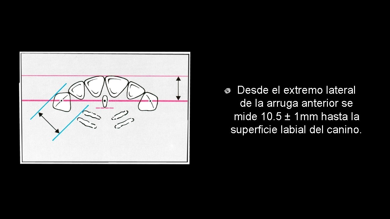 Desde el extremo lateral de la arruga anterior se mide 10. 5 ± 1