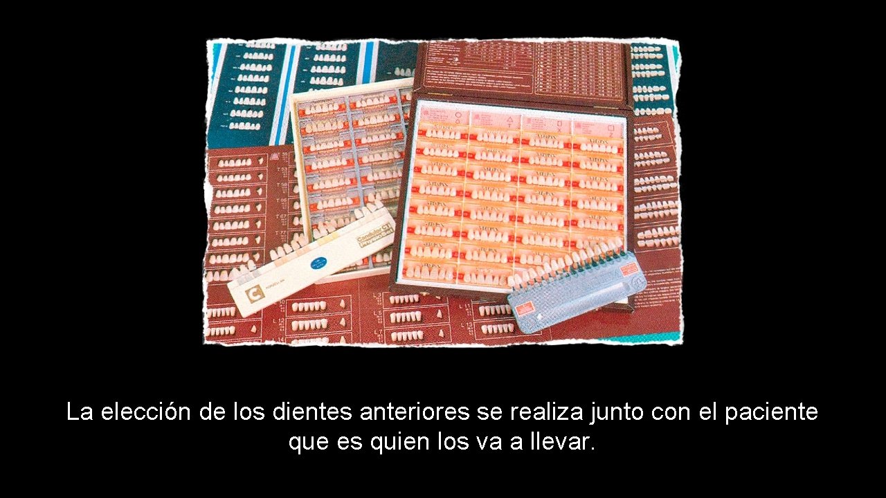 La elección de los dientes anteriores se realiza junto con el paciente que es