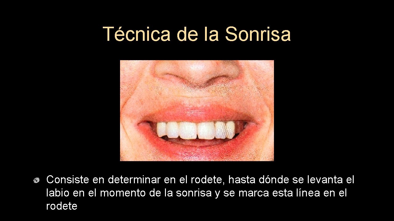 Técnica de la Sonrisa Consiste en determinar en el rodete, hasta dónde se levanta
