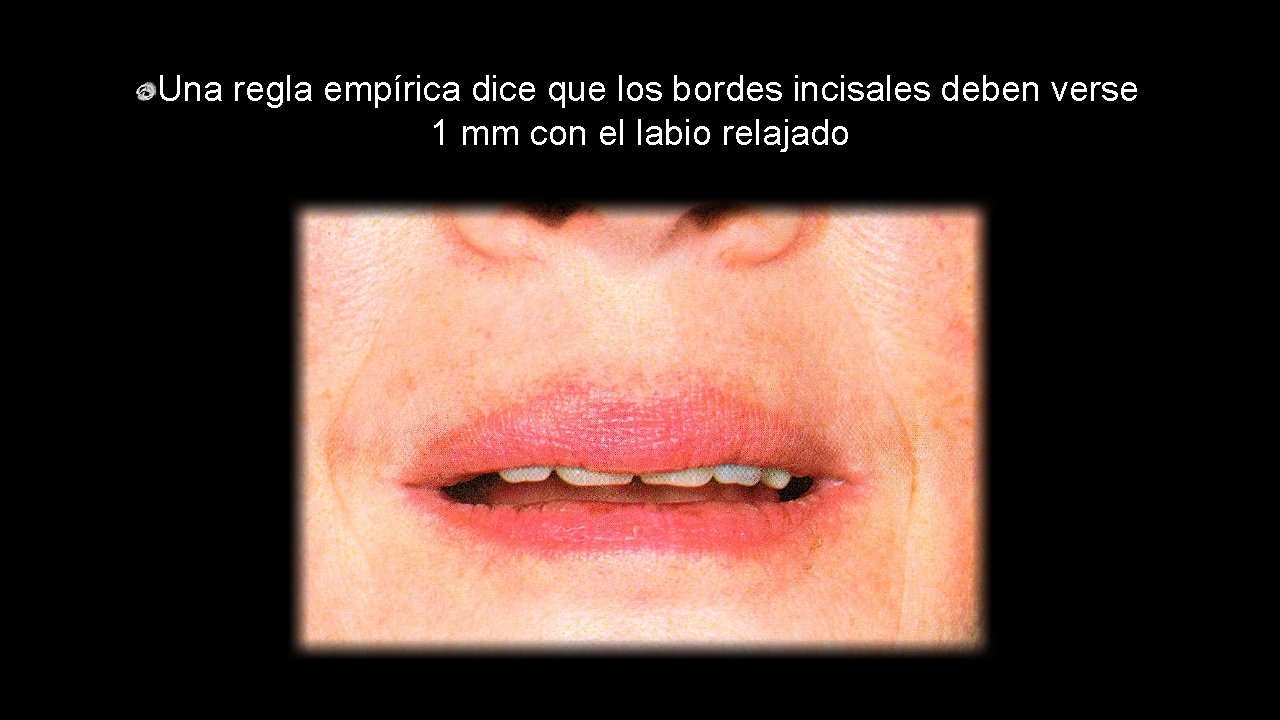 Una regla empírica dice que los bordes incisales deben verse 1 mm con el