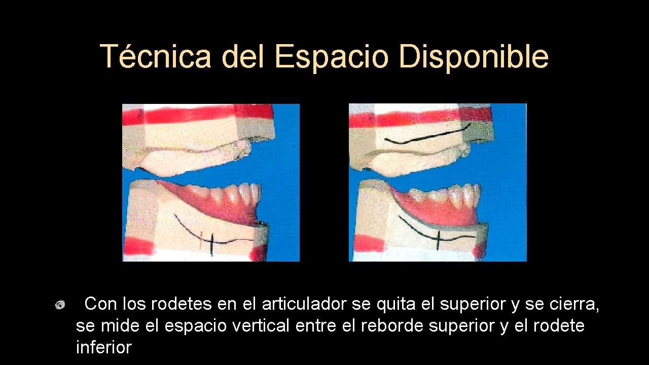 Técnica del Espacio Disponible Con los rodetes en el articulador se quita el superior